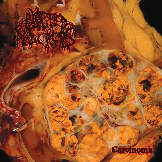 BLASTED PANCREAS - Carcinoma LP (red)