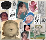 CRANIORACHISCHISIS - Craniorachischisis CD CRANIORACHISCHISIS - Craniorachischisis CD