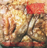 LYMPHATIC PHLEGM - Malignant Cancerous Tumor In The Epitelial Tissue Of The Intestine LP